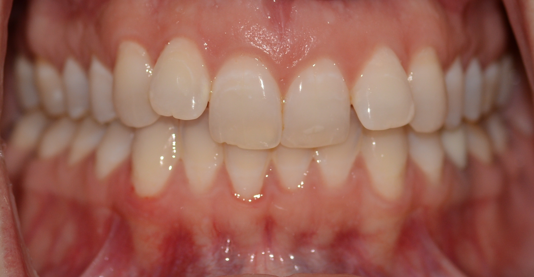 Overbite